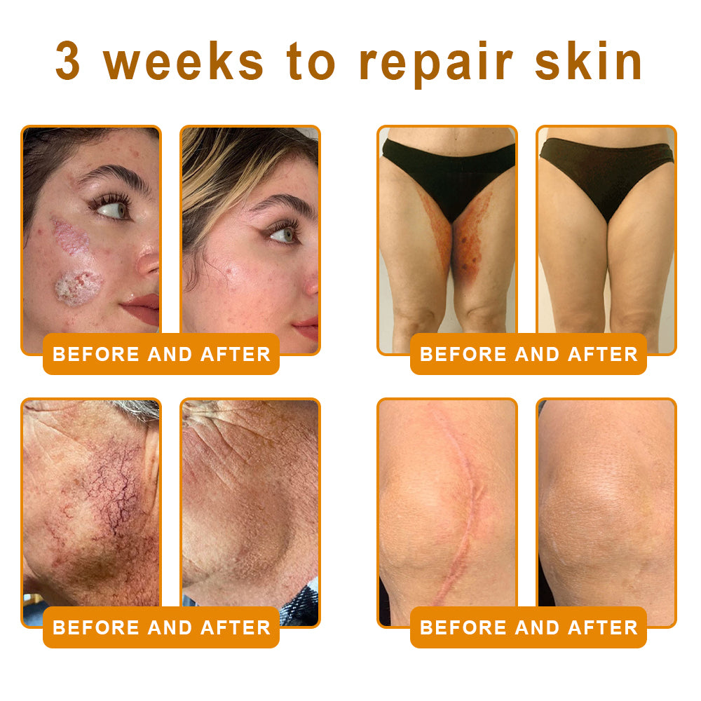 𝙑𝙇𝙎𝙑𝙇𝙎® 𝘽𝙀𝙀 𝙑𝙀𝙉𝙊𝙈 𝑺𝒌𝒊𝒏 𝑹𝒆𝒔𝒕𝒐𝒓𝒂𝒕𝒊𝒐𝒏 𝑪𝒓𝒆𝒂𝒎 –🌸 Anti-aging,Hydrating, Skin Repair, Even Tone, Acne and Dark Spot Treatment, Wart and Mole Removal, Psoriasis Relief