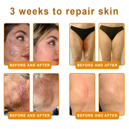 𝙑𝙇𝙎𝙑𝙇𝙎® 𝘽𝙀𝙀 𝙑𝙀𝙉𝙊𝙈 𝑺𝒌𝒊𝒏 𝑹𝒆𝒔𝒕𝒐𝒓𝒂𝒕𝒊𝒐𝒏 𝑪𝒓𝒆𝒂𝒎 –🌸 Anti-aging,Hydrating, Skin Repair, Even Tone, Acne and Dark Spot Treatment, Wart and Mole Removal, Psoriasis Relief