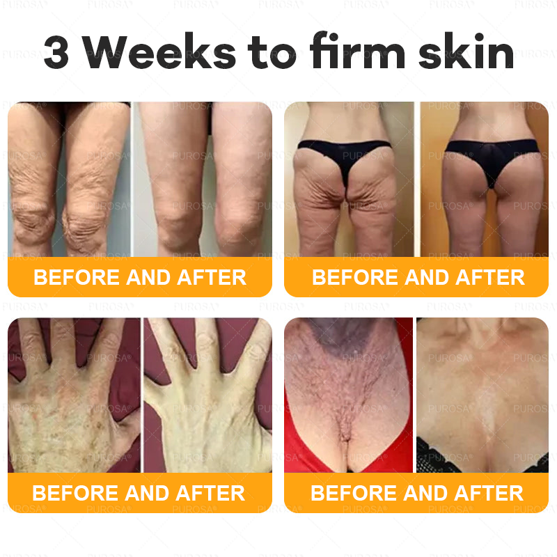 𝑷𝑼𝑹𝑶𝑺𝑨® 𝘽𝙀𝙀 𝙑𝙀𝙉𝙊𝙈 𝙎𝙠𝙞𝙣 𝙍𝙚𝙨𝙩𝙤𝙧𝙖𝙩𝙞𝙤𝙣 𝘾𝙧𝙚𝙖𝙢 – 🌸Targets Sagging Skin, Fine Lines, and Loss of Firmness on Chest, Neck & Body | Lifts & Firms Naturally 🔥 LAST DAY: 80% OFF!