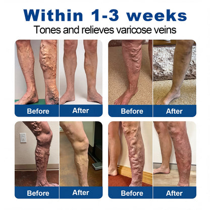 🇺🇸👨‍⚕️✅✅Lexasky® VEIN EASE MICRONEEDLE CARE PATCH⚡Instant Relief, Long-Term Results