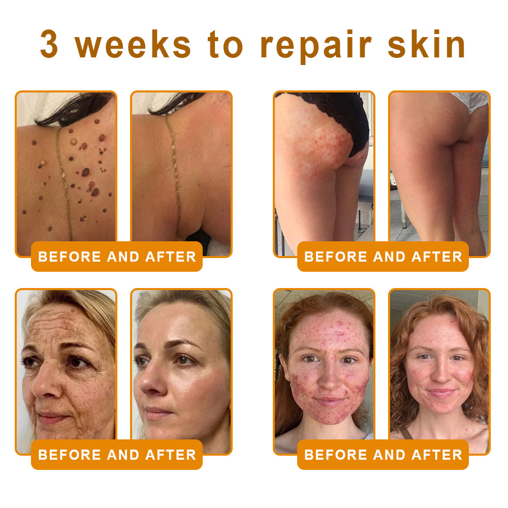 𝑷𝑼𝑹𝑶𝑺𝑨® 𝘽𝙀𝙀 𝙑𝙀𝙉𝙊𝙈 𝙎𝙠𝙞𝙣 𝙍𝙚𝙨𝙩𝙤𝙧𝙖𝙩𝙞𝙤𝙣 𝘾𝙧𝙚𝙖𝙢 – 🌸Targets Sagging Skin, Fine Lines, and Loss of Firmness on Chest, Neck & Body | Lifts & Firms Naturally 🔥 LAST DAY: 80% OFF!