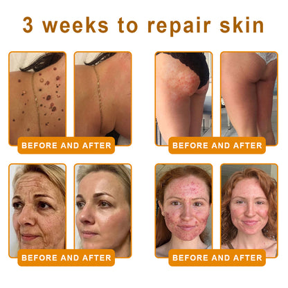 𝙑𝙇𝙎𝙑𝙇𝙎® 𝘽𝙀𝙀 𝙑𝙀𝙉𝙊𝙈 𝑺𝒌𝒊𝒏 𝑹𝒆𝒔𝒕𝒐𝒓𝒂𝒕𝒊𝒐𝒏 𝑪𝒓𝒆𝒂𝒎 –🌸 Anti-aging,Hydrating, Skin Repair, Even Tone, Acne and Dark Spot Treatment, Wart and Mole Removal, Psoriasis Relief