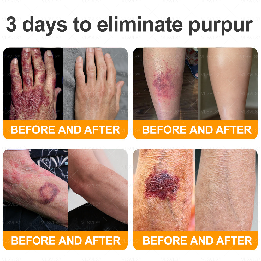 𝑷𝑼𝑹𝑶𝑺𝑨® 𝘽𝙀𝙀 𝙑𝙀𝙉𝙊𝙈 𝙎𝙠𝙞𝙣 𝙍𝙚𝙨𝙩𝙤𝙧𝙖𝙩𝙞𝙤𝙣 𝘾𝙧𝙚𝙖𝙢 – 🌸Targets Sagging Skin, Fine Lines, and Loss of Firmness on Chest, Neck & Body | Lifts & Firms Naturally 🔥 LAST DAY: 80% OFF!