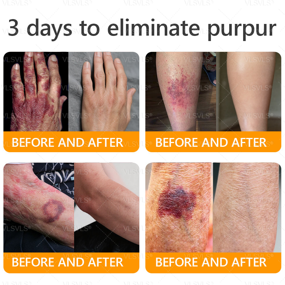 𝙑𝙇𝙎𝙑𝙇𝙎® 𝘽𝙀𝙀 𝙑𝙀𝙉𝙊𝙈 𝑺𝒌𝒊𝒏 𝑹𝒆𝒔𝒕𝒐𝒓𝒂𝒕𝒊𝒐𝒏 𝑪𝒓𝒆𝒂𝒎 –🌸 Anti-aging,Hydrating, Skin Repair, Even Tone, Acne and Dark Spot Treatment, Wart and Mole Removal, Psoriasis Relief